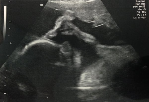 Baby ultrasound